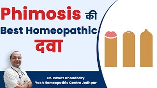 Best Homeopathic Medicine for Phimosis  Phimosis का बिना ऑपरेशन के इलाज Best Treatment of Phimosis [upl. by Philis]