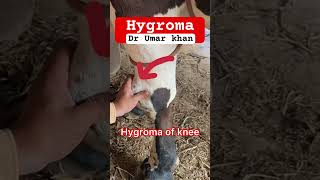 Hygroma of knee l dr Umar khan [upl. by Xilef]