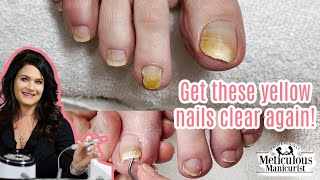 Thick Toenails Remedy [upl. by Freddie]