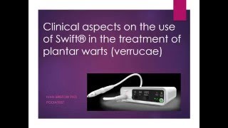 Suggested Treatment For Verrucae Using Swift Microwave Technology [upl. by Aseeram]