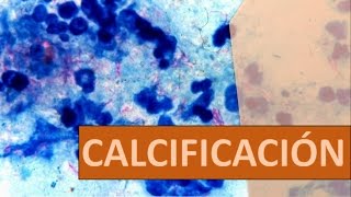 CALCIFICACIÓN  PATOLOGIA 12 [upl. by Kline]