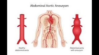 Understanding Abdominal Aortic Aneurysm What You Need to Know shorts youtubeshorts [upl. by Ralyks]