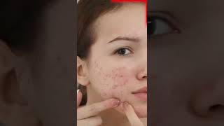 STOP Popping Those Pimples Before Its Too Late [upl. by Enneite]