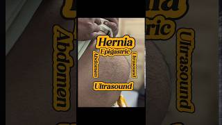 Epigaric Hernia  Wall Defect Gap  Hernia  Ultrasound  Surgery  Mesh [upl. by Lhamaj355]