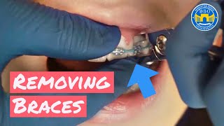 Process of Removing Braces [upl. by Mandelbaum]