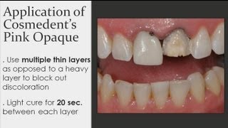 Composite Veneer  Masking Discolored Teeth [upl. by Halika]