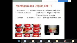 Aula 7 220421  Montagem dos Dentes Ceroplastia e Acrilização da Prótese Total [upl. by Malina]