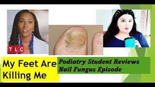 Podiatry Student reviews Brandon Never Washes His Feet  My Feet Are Killing Me nailfungus [upl. by Nyloj]