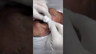 Pimple Popping Pop pimple pimple pimplepop acne blackhead pimplepopping pimples [upl. by Helsa]