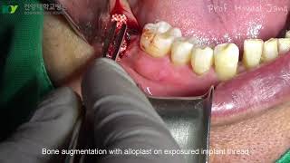 Surgical Regenerative Treatment of PeriImplantitis with TiBrush [upl. by Stillmann]