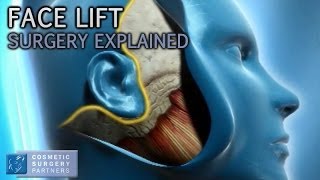 Facelift Surgery Explained  Cosmetic Surgery Video Animation [upl. by Winston265]