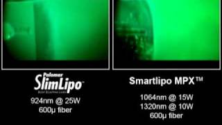 Video of Laser Liposuction Comparing SlimLipo vs SmartLipo and Lipotherme [upl. by Ahsael]