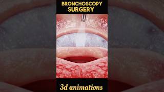 Bronchoscopy Surgery process viral shorts bronchoscopy 3d [upl. by Chambers]