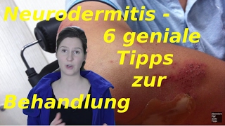 Neurodermitis Gesicht  6 Tipps zur Behandlung [upl. by Odnalro]