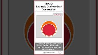 Heartmate LVAD EOGO Extrinsic Outflow Graft Obstruction shorts lvad [upl. by Anoi692]