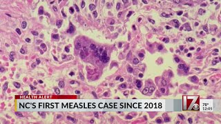 First measles case reported in NC since 2018 [upl. by Haodnanehs207]