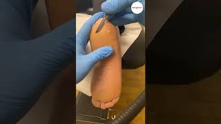 Thick Heel Skin Callus Removal With A Scalpel In Podiatry Clinic [upl. by Oidacra631]