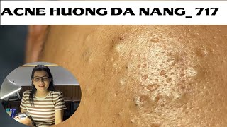 Acne Treatment Huong Da Nang 717  Remove Blackheads [upl. by Friederike]