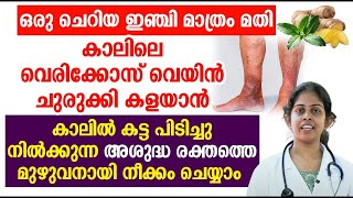 ഒരു ചെറിയ ഇഞ്ചി മാത്രം അതി കാലിലെ വെരിക്കോസ് വെയിൻ ചുരുക്കി കളയാൻ  Varicose veins Malayalam [upl. by Rosenberger933]