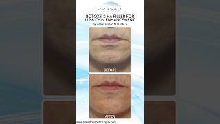 How Botox for Chin Dimpling Works botox [upl. by Herby]