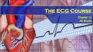 The ECG Course  AV Blocks [upl. by Carree]