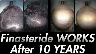 10 YEARS ON FINASTERIDE Results of Italian Study [upl. by Tsepmet186]