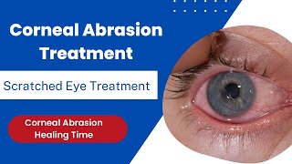 Corneal Abrasion Treatment  Scratched Eye Treatment  Corneal Abrasion Healing Time [upl. by Kciredorb]