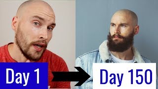 5 MONTH MINOXIDIL BEARD TRANSFORMATION [upl. by Reagen]