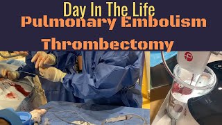 Interventional Radiology  Day in the Life  Episode 2  PE Thrombectomy [upl. by Allerie335]