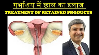 गर्भाशय में छाल का इलाज  TREATMENT OF RETAINED PRODUCTS [upl. by Ecirehs]