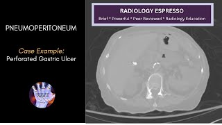 PNEUMOPERITONEUM Case Example – Pneumoperitoneum on CT Perforated Gastric Ulcer [upl. by Favata]