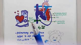 What are congenital heart defects What is ASDVSDPDA Tetralogy of fallot coarctaction of aorta [upl. by Nerval757]