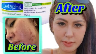 I TRIED CETAPHIL MOISTURIZING CREAM for my ACNE PRONE SKIN  DRY OILY SKINCOMBINATION  IT SAVE ME [upl. by Are]