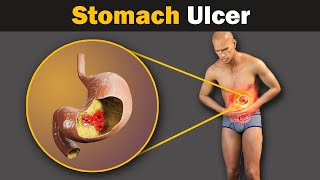 What causes a stomach ulcer Animation [upl. by Epuladaugairam]