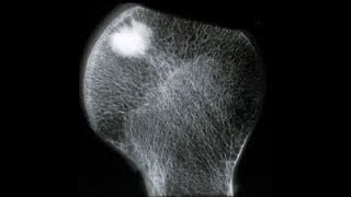 X ray video showing Bone island Enostosis [upl. by Serilda]