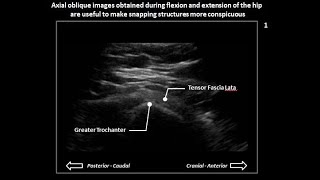 Lateral snapping hip syndrome coxa saltans on dynamic hip ultrasound case 3 [upl. by Akihsat]