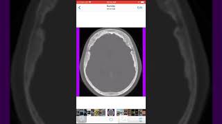 Case 046 Hyperostosis frontalis interna [upl. by Annahvas]