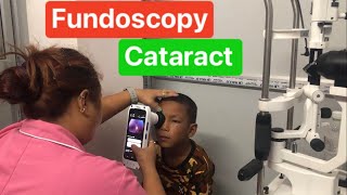 Fundoscopy  Retina  Congenital Cataract [upl. by Leakcim]