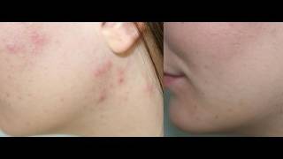 HOW TO CURE ACNE BREAKOUTS [upl. by Doss100]