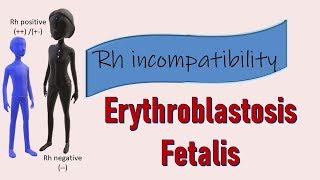 Rh incompatibility II Erythroblastosis fetalis II Prevention with Rhogam [upl. by Aicert]