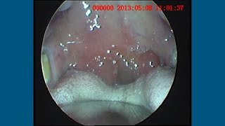 Peritonsillitis with Severe Uvula Oedema [upl. by Reo716]