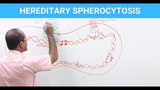 Hereditary Spherocytosis  Diagnosis amp Treatment  Genetics👨‍⚕️ [upl. by Aluor1]