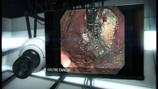 Gastric Cancer [upl. by Idalina]