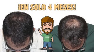 🔴¡¡RECUPERÓ SU PELO EN SOLO 4 MESES😱 [upl. by Eeryk]