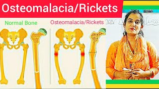 Osteomalacia amp Rickets  Cause Symptom Treatment Diagnosis MedicalSurgical amp Nursing Management [upl. by Cacka]