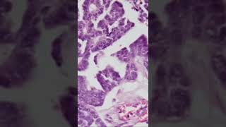 High Grade Serous Carcinoma of Ovary  Pathology shorts [upl. by Turtle]