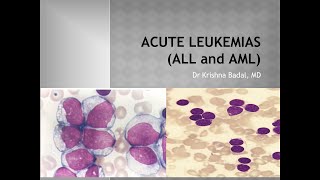 Acute leukemias ALL and AML [upl. by Routh]