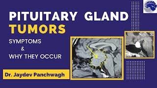 Pituitary Gland Tumour Symptoms Dr Jaydev Panchwagh Neurosurgeon Pune [upl. by Nywroc]