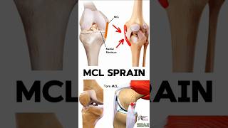 Management and Treatment of MCL Sprains in Adults medical animation 3d short [upl. by Yeloc876]