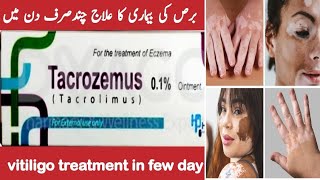 Tacrozemus ointment  eczema Causes amp Treatment  How to get rid of Eczema  vitiligo Skin Care [upl. by Jackqueline]